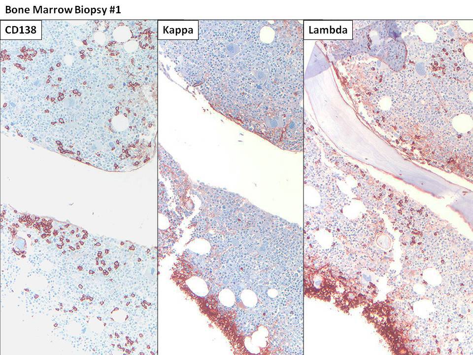 Bone marrow immunohistochemistry #1: Plasma cells comprise 10-15% of cells in the biopsy and are lambda light chain-restricted.